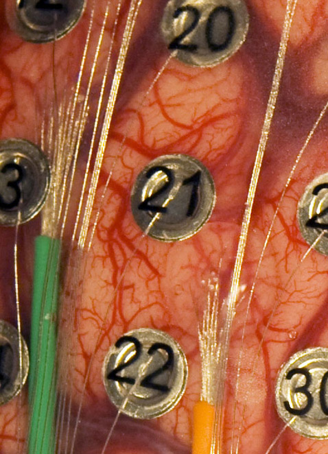Пучки тончайших проводков, сгруппированных в зелёный и оранжевый кабели, подходят к тонким и прозрачным силиконовым "пластырям"  (на снимке они едва заметны), заполненным массивом микроскопических электродов (фото University of Utah Department of Neurosurgery).
