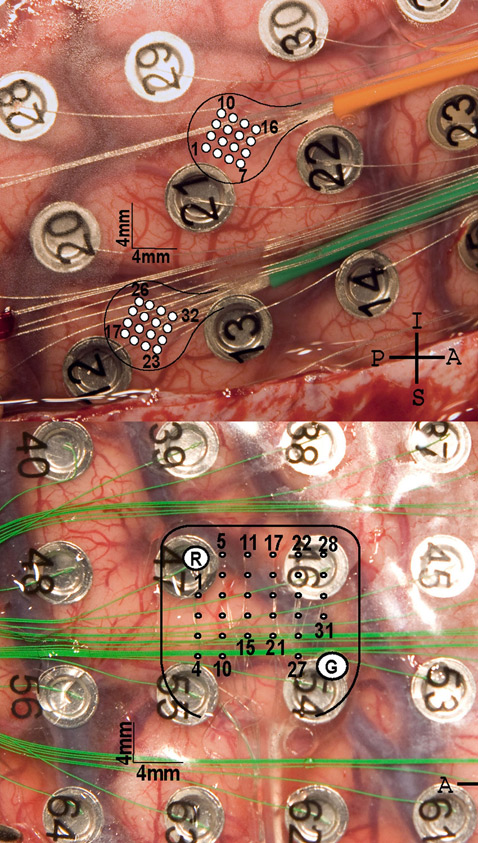      . :          16   . :       32  ( Neurosurgical Focus/University of Utah Department of Neurosurgery).