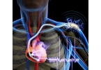 Имплантанты сердца становятся технологичнее