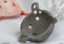 Врачи провели операцию по установке 3D-печатного эндопротеза